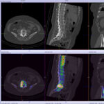 R-L45-disc-and-foraminal-impingement-on-MRI-smaller