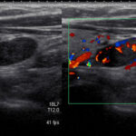 R-lower-pole-PTH-on-ultrasound-study