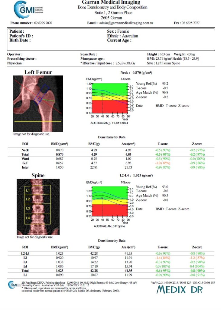 Dxa Scan Results